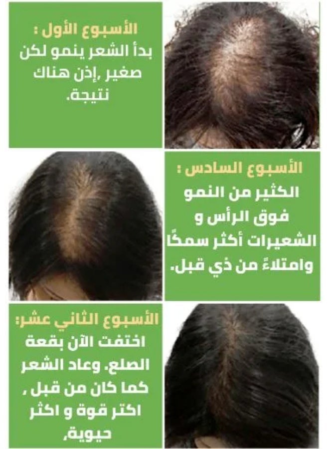 EELHOE Rosemary Essential Oil For Hair Growth & Skin Care 30 ml - Image 3